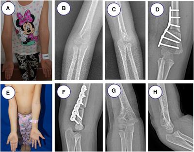 Locking plate versus K-wires and cast fixation in lateral closing-wedge osteotomy for cubitus varus deformity